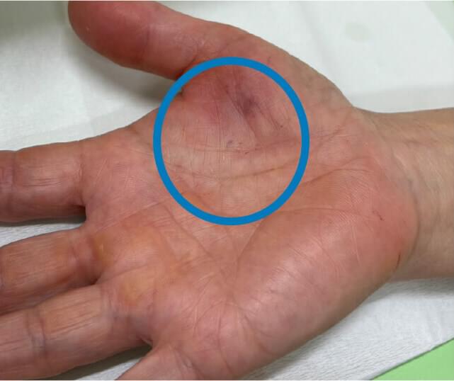 After:右手拇指术后