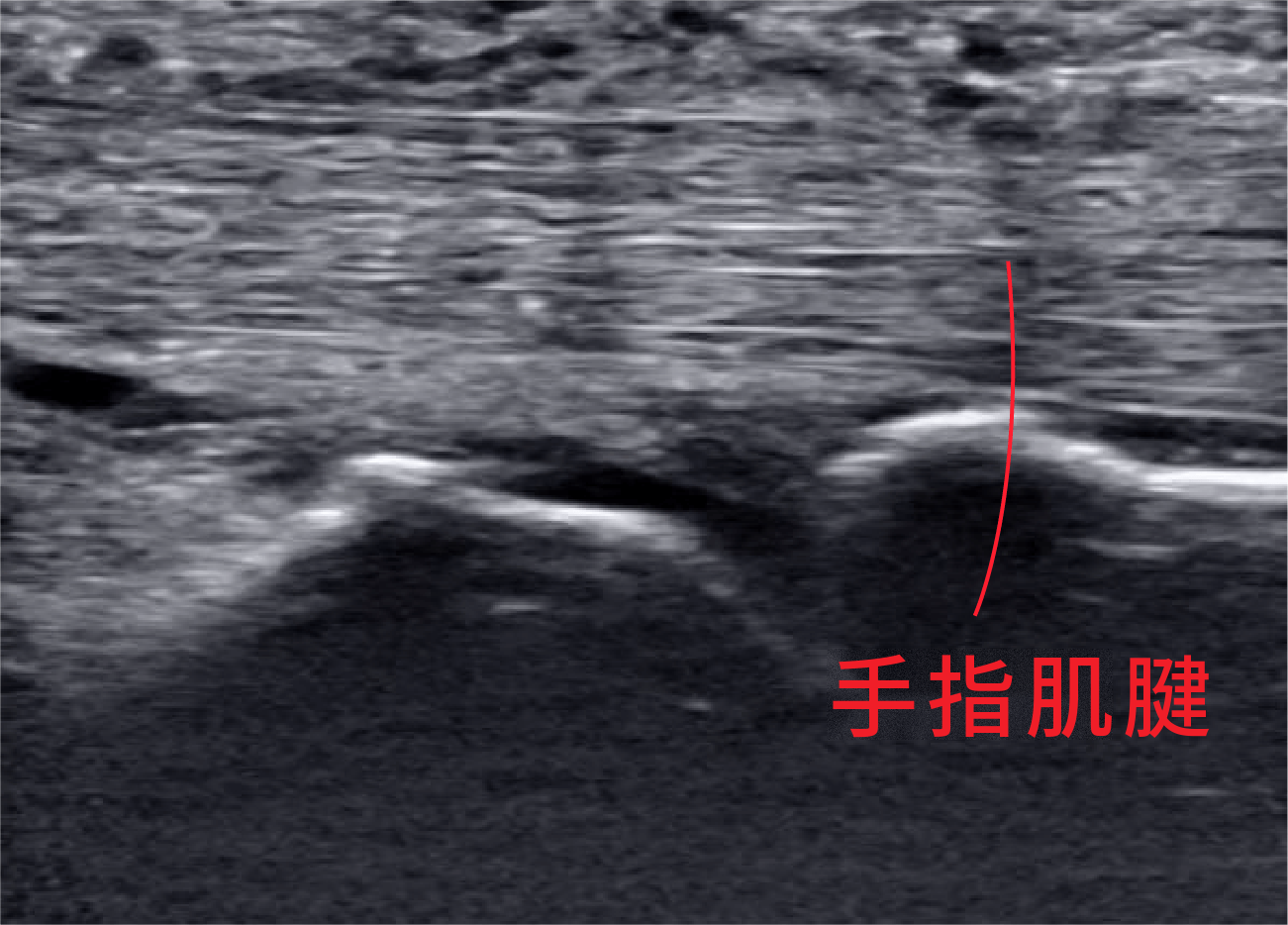 手指肌腱的超声图像