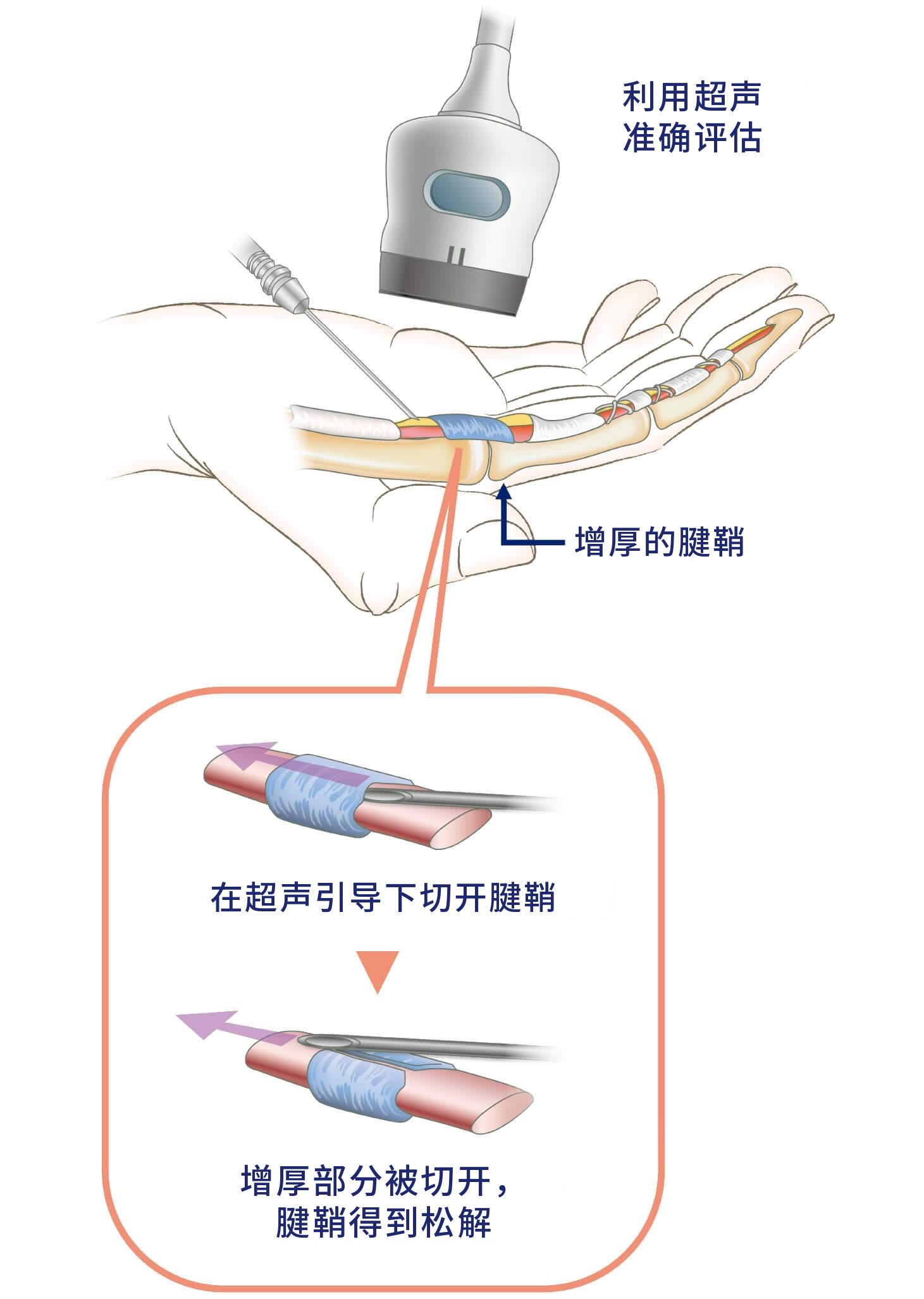 超声引导下经皮腱鞘切开术