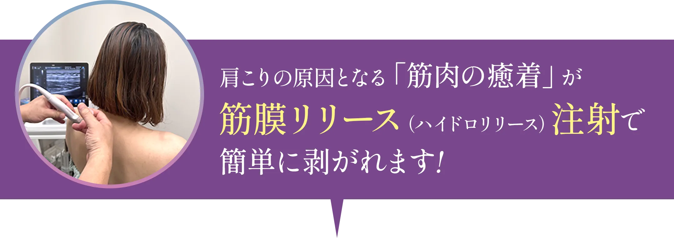 肩こりの原因となる「筋肉の癒着が」筋膜リリース（ハイドロリリース）で簡単に剥がれます！